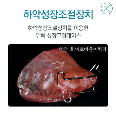 설측교정장치