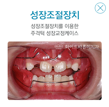 설측교정장치