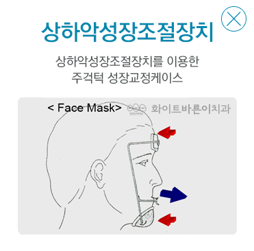 설측교정장치