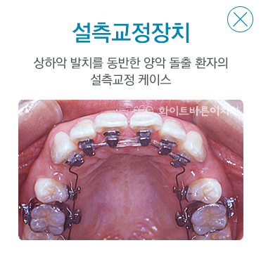 설측교정장치