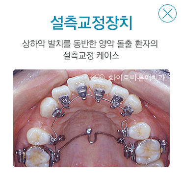 설측교정장치