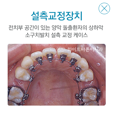 설측교정장치