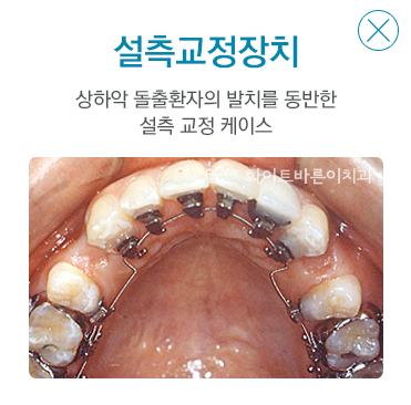 설측교정장치