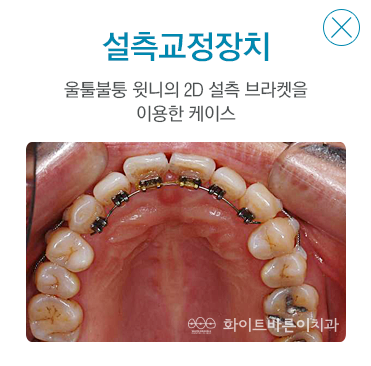 설측교정장치